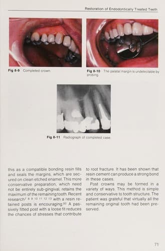 Aesthetic Dentistry with Indirect Resins