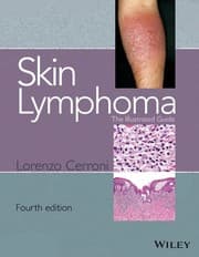 Skin lymphoma